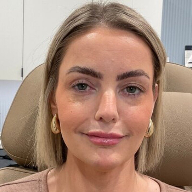 Botox & Dysport Before & After Image