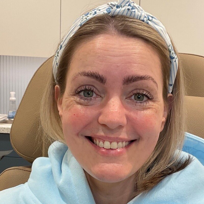 Botox & Dysport Before & After Image