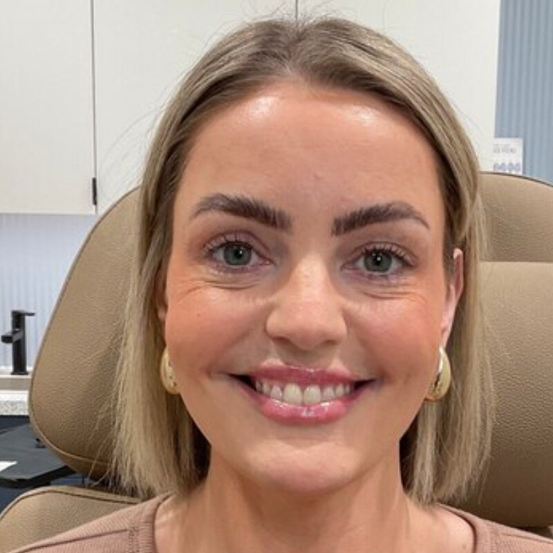 Botox & Dysport Before & After Image