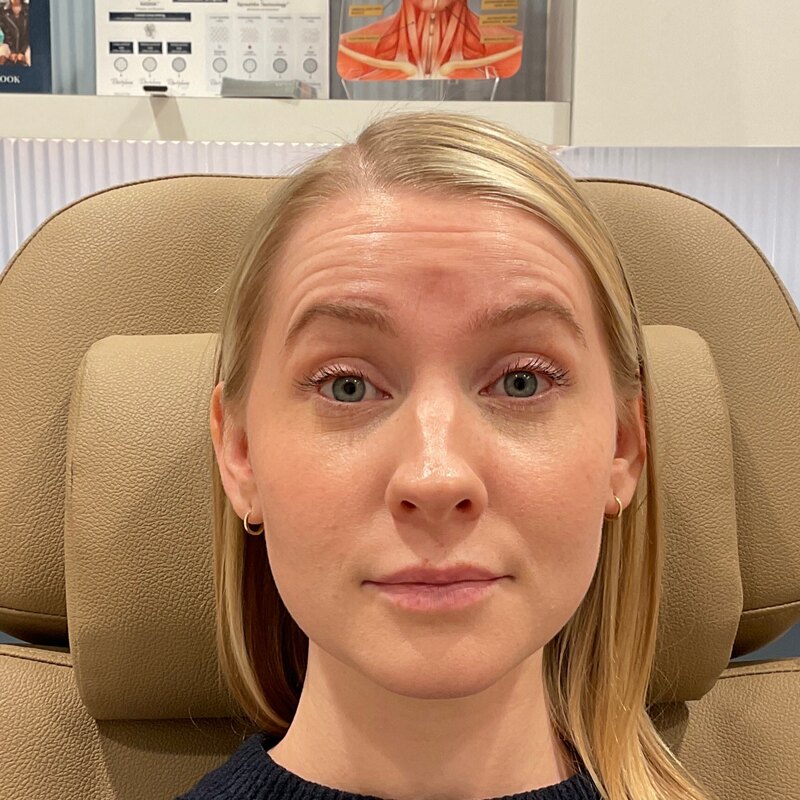 Botox & Dysport Before & After Image