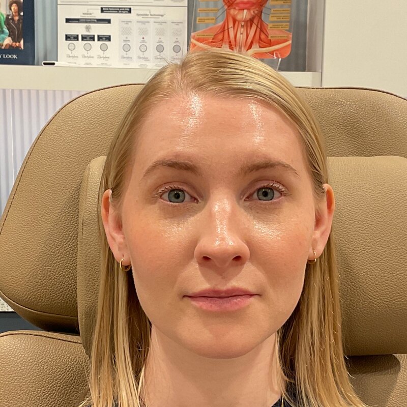 Botox & Dysport Before & After Image