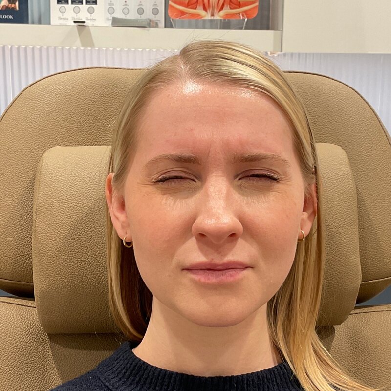 Botox & Dysport Before & After Image