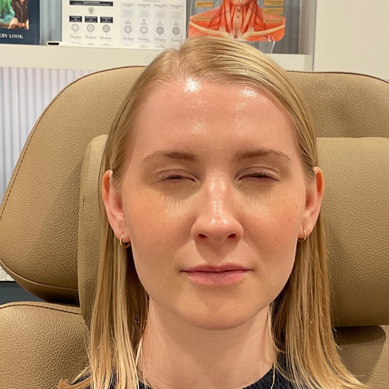 Botox & Dysport Before & After Image