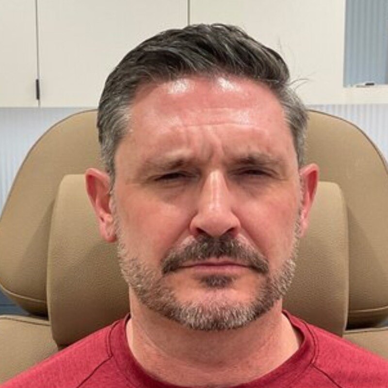 Botox & Dysport Before & After Image