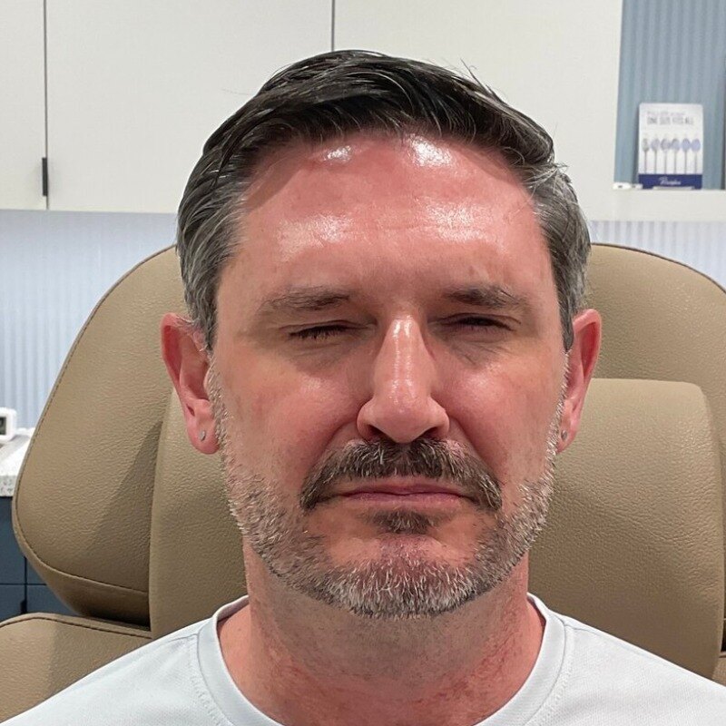 Botox & Dysport Before & After Image