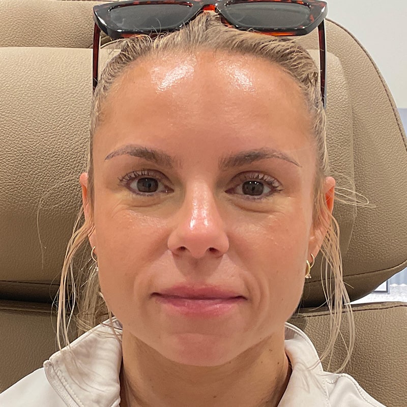 Dermal Fillers Before & After Image