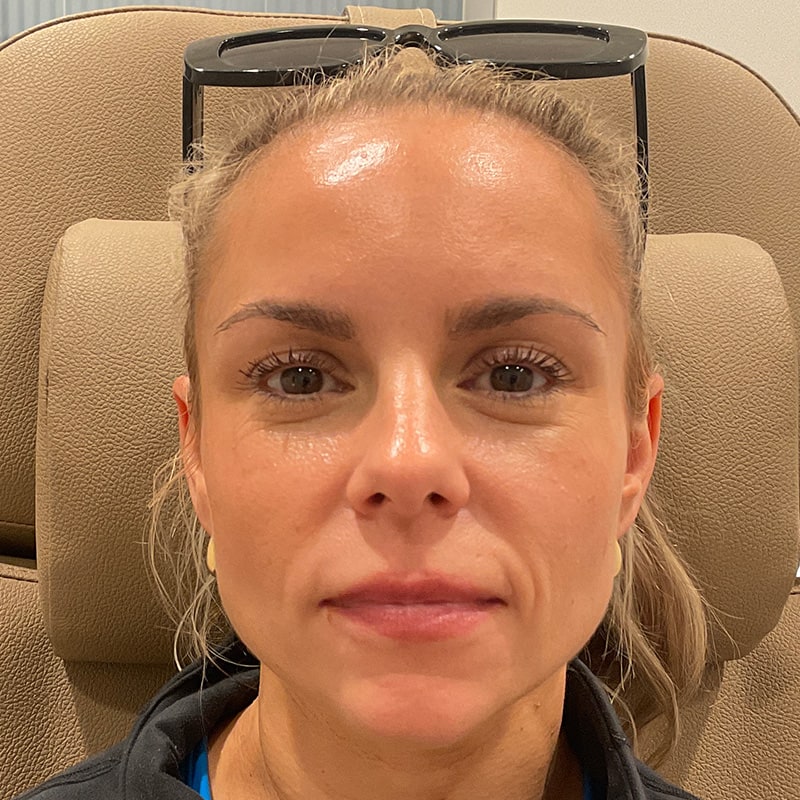 Dermal Fillers Before & After Image