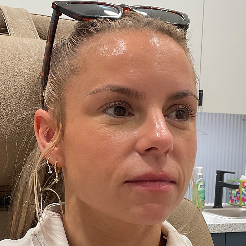 Dermal Fillers Before & After Image