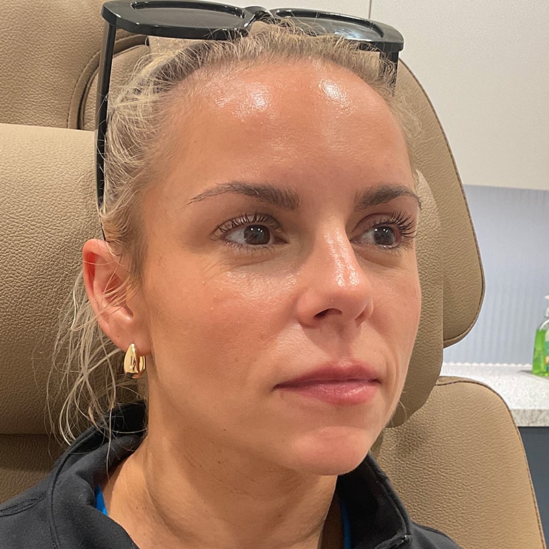 Dermal Fillers Before & After Image