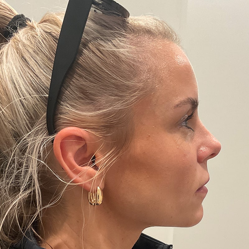 Dermal Fillers Before & After Image