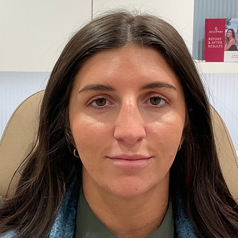 Dermal Fillers Before & After Image