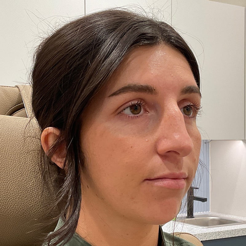 Dermal Fillers Before & After Image