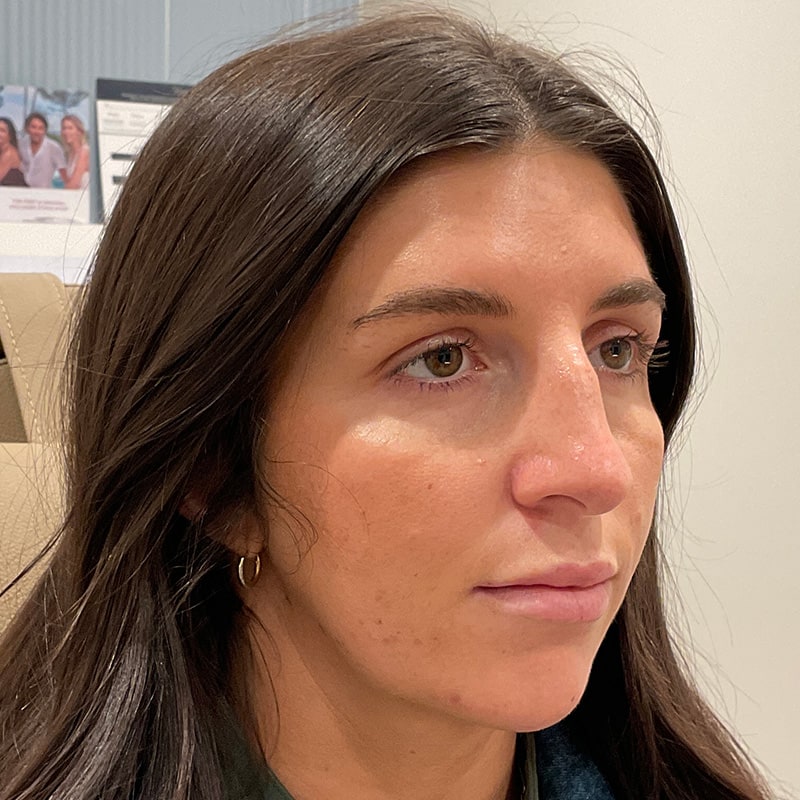 Dermal Fillers Before & After Image