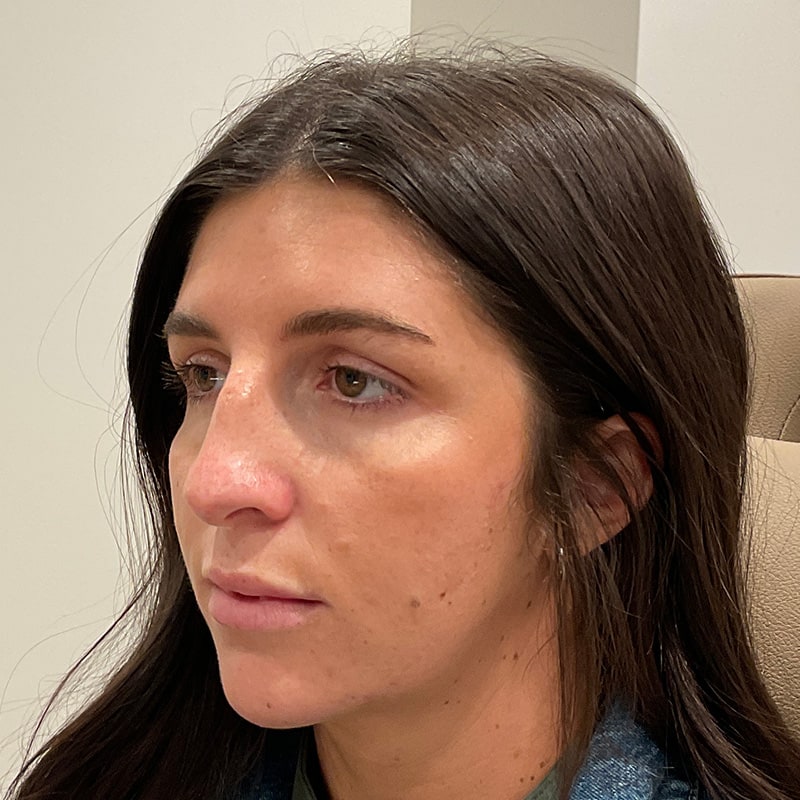 Dermal Fillers Before & After Image