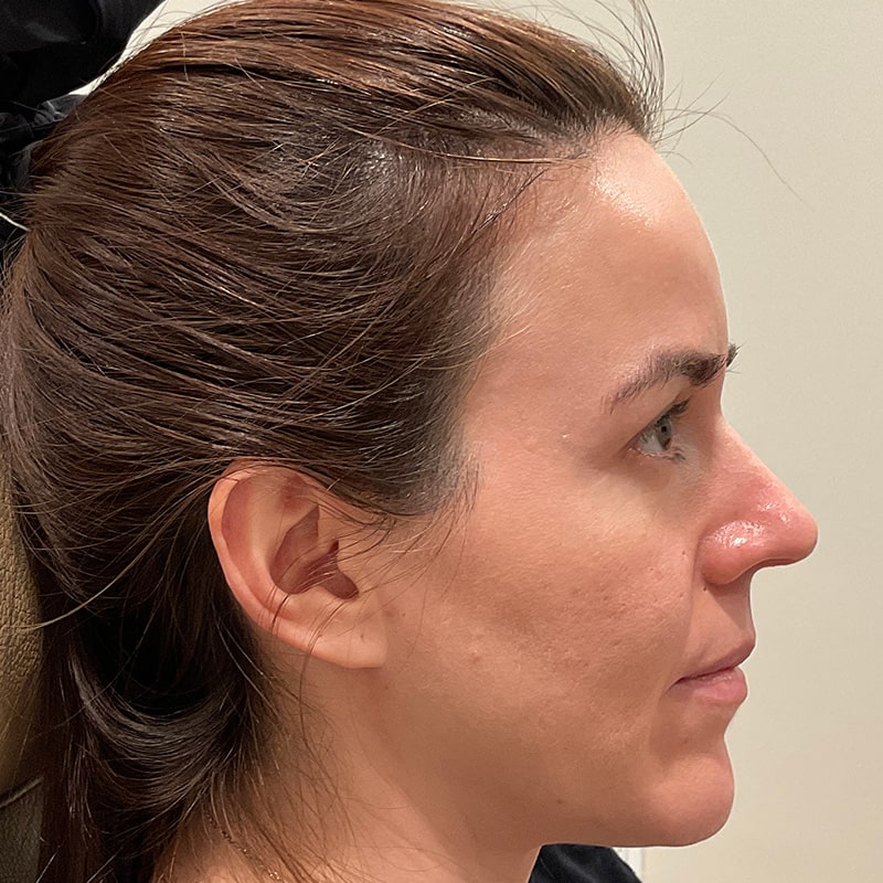 Dermal Fillers Before & After Image