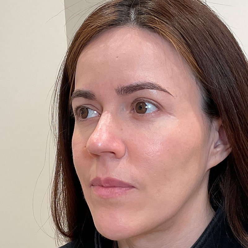 Dermal Fillers Before & After Image