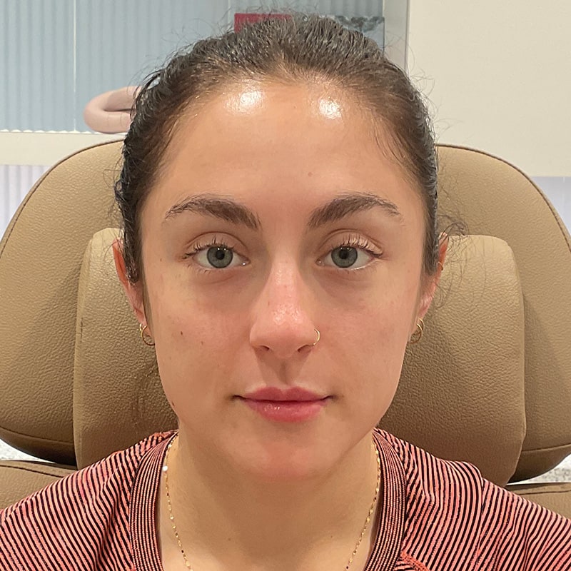 Dermal Fillers Before & After Image