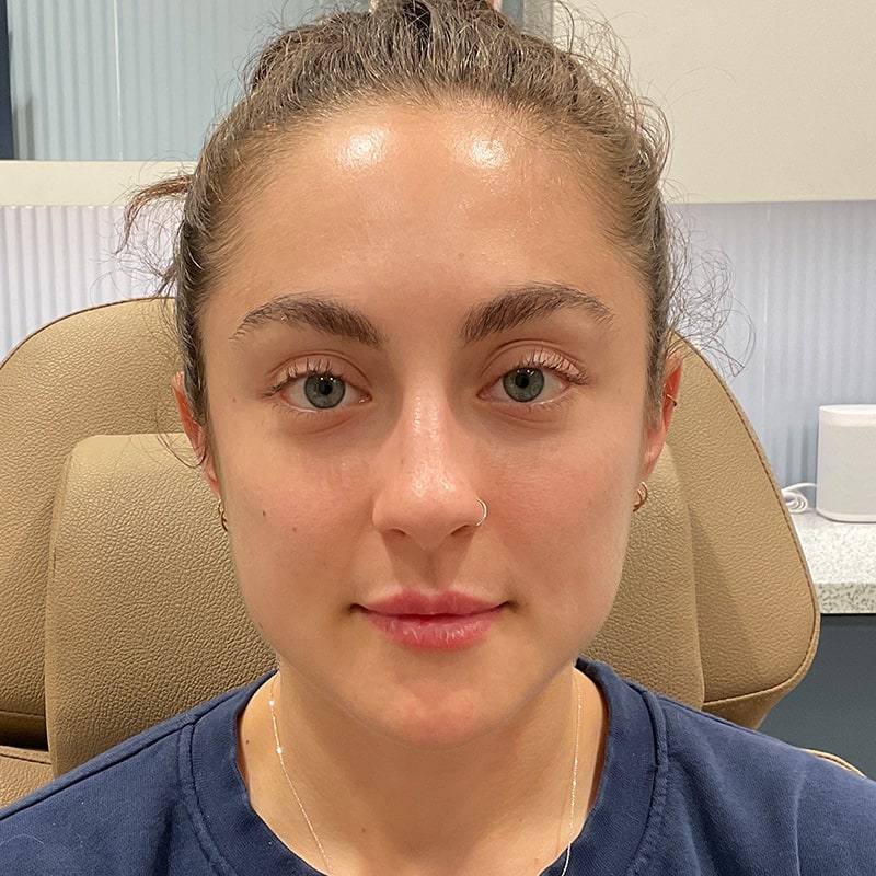 Dermal Fillers Before & After Image