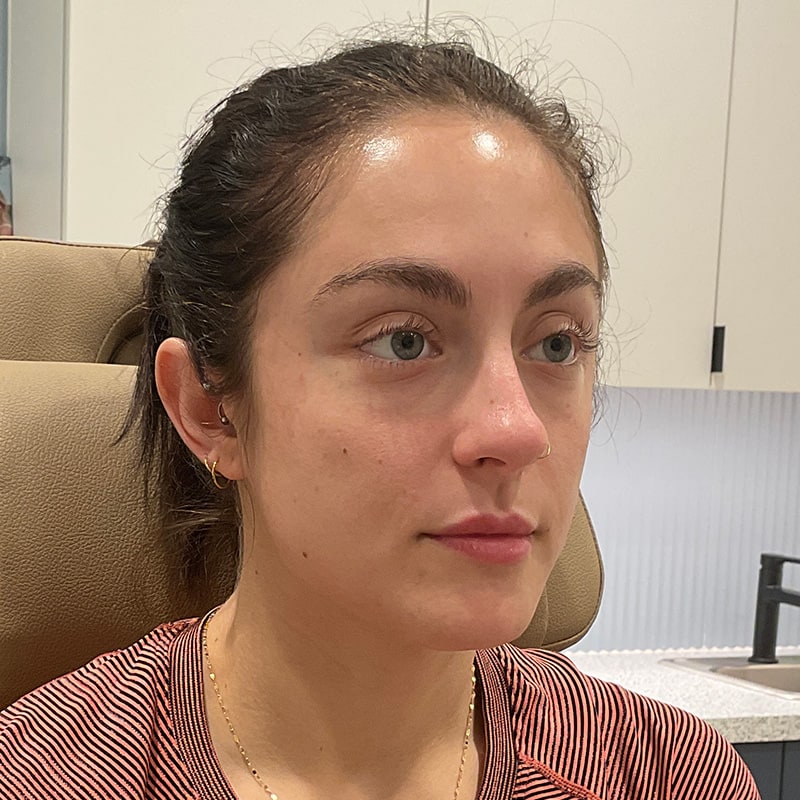 Dermal Fillers Before & After Image