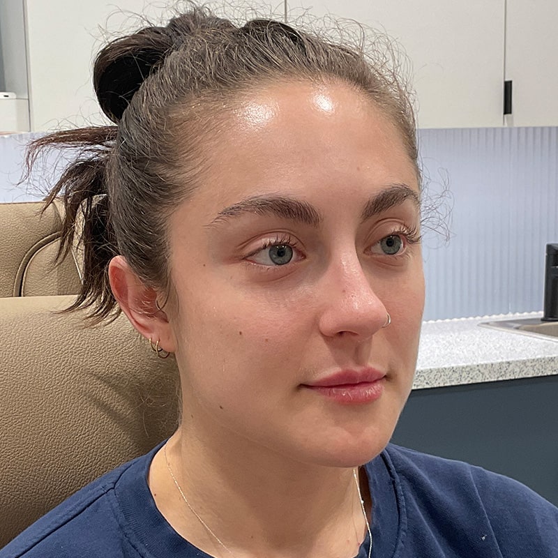 Dermal Fillers Before & After Image