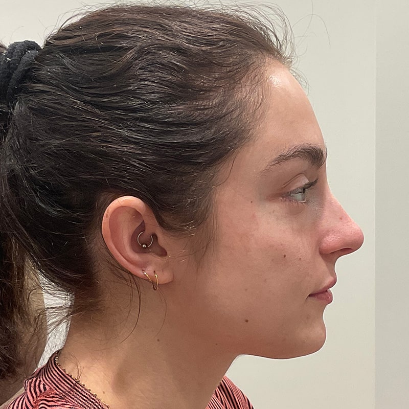 Dermal Fillers Before & After Image