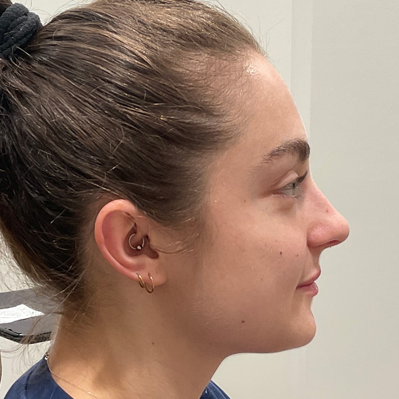 Dermal Fillers Before & After Image