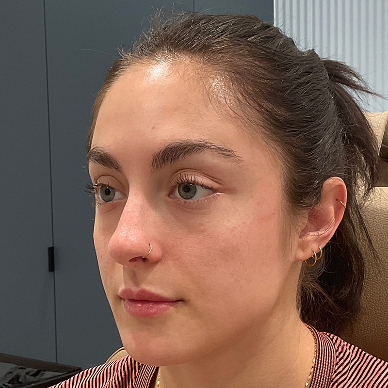 Dermal Fillers Before & After Image