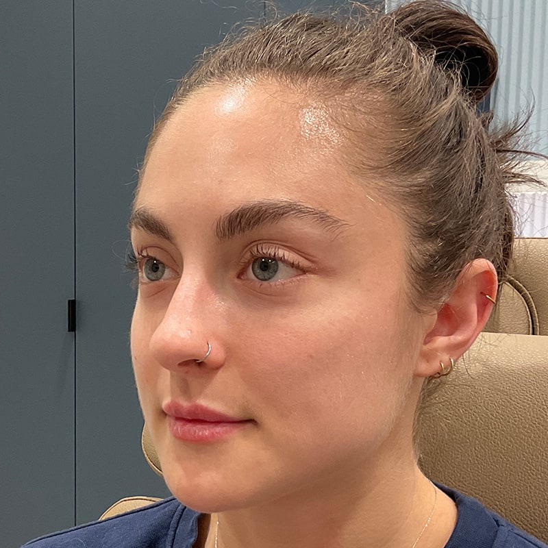 Dermal Fillers Before & After Image