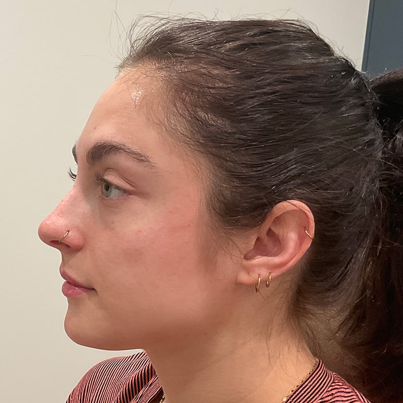 Dermal Fillers Before & After Image