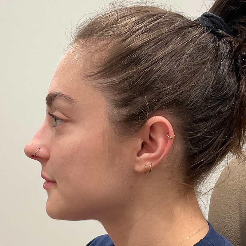 Dermal Fillers Before & After Image