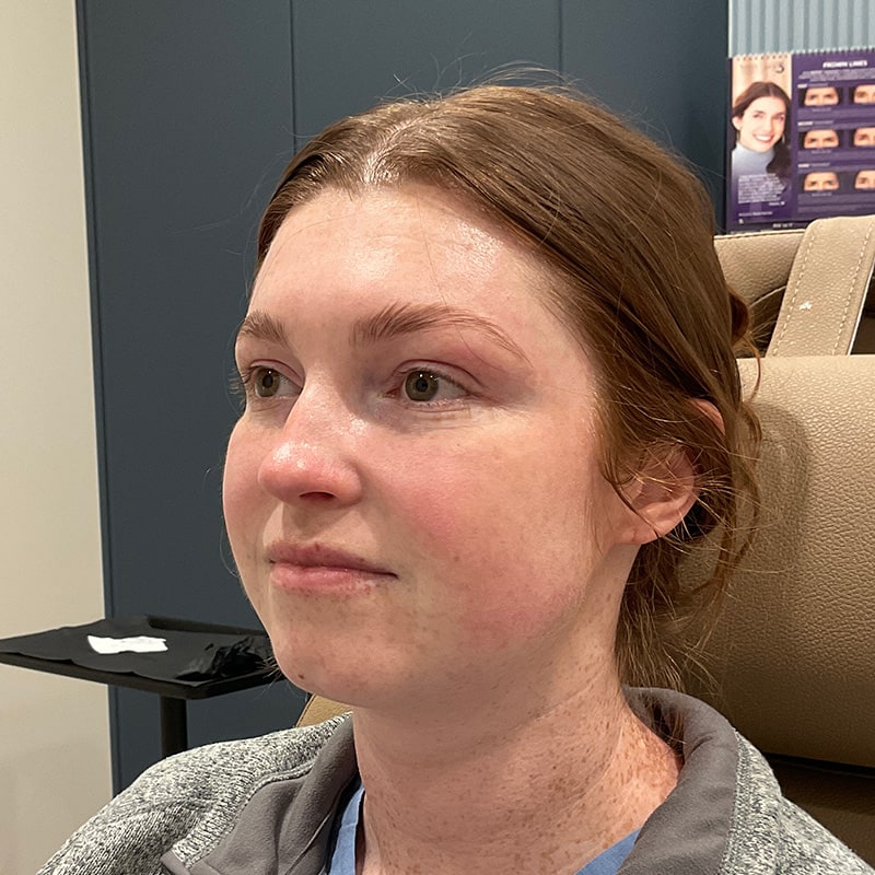 Dermal Fillers Before & After Image