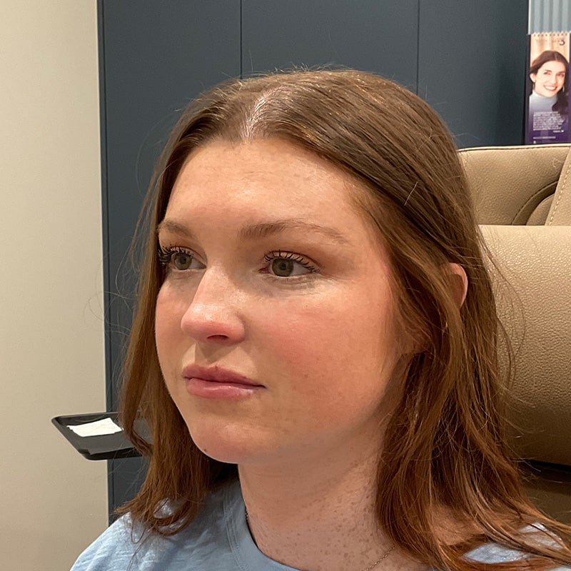 Dermal Fillers Before & After Image