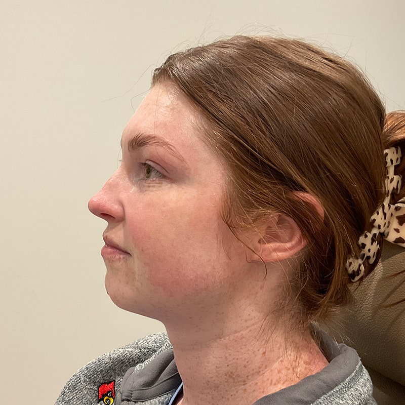 Dermal Fillers Before & After Image