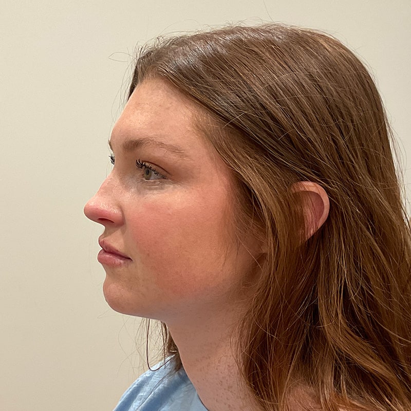 Dermal Fillers Before & After Image