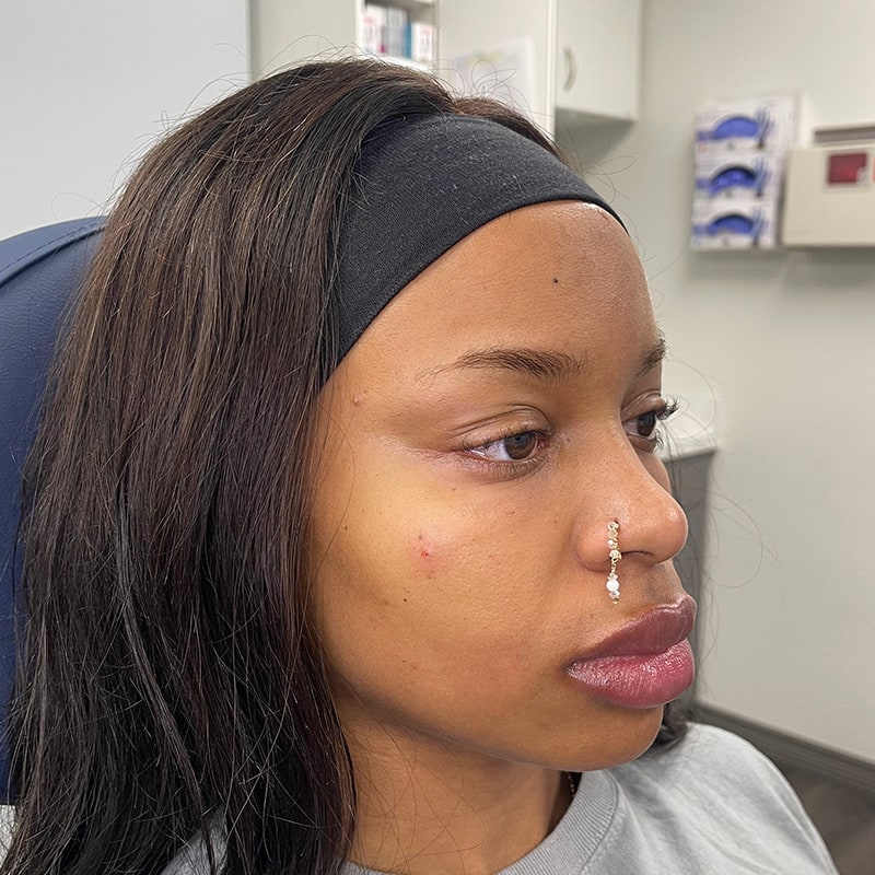 Dermal Fillers Before & After Image