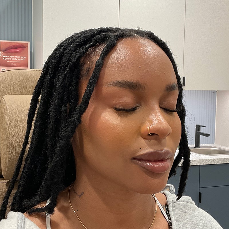 Dermal Fillers Before & After Image