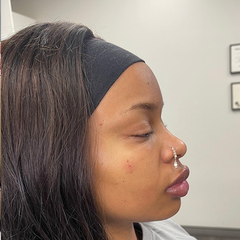 Dermal Fillers Before & After Image