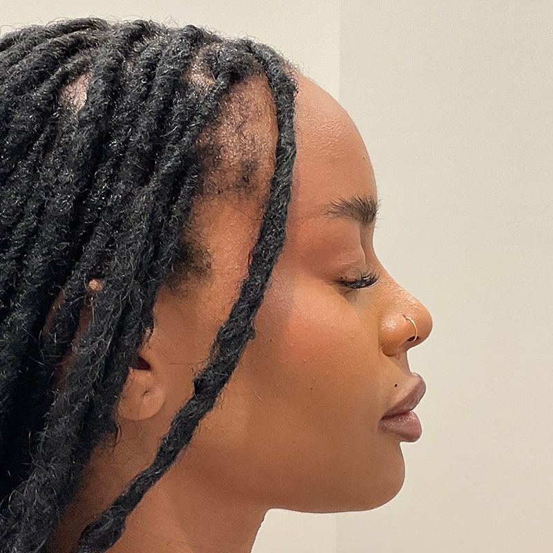 Dermal Fillers Before & After Image