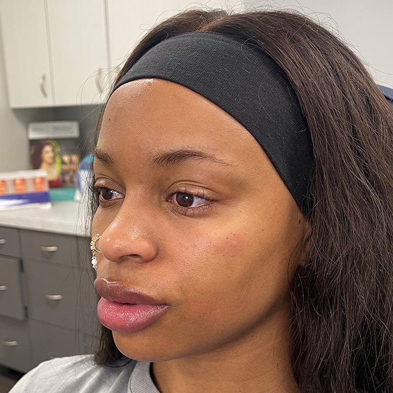 Dermal Fillers Before & After Image