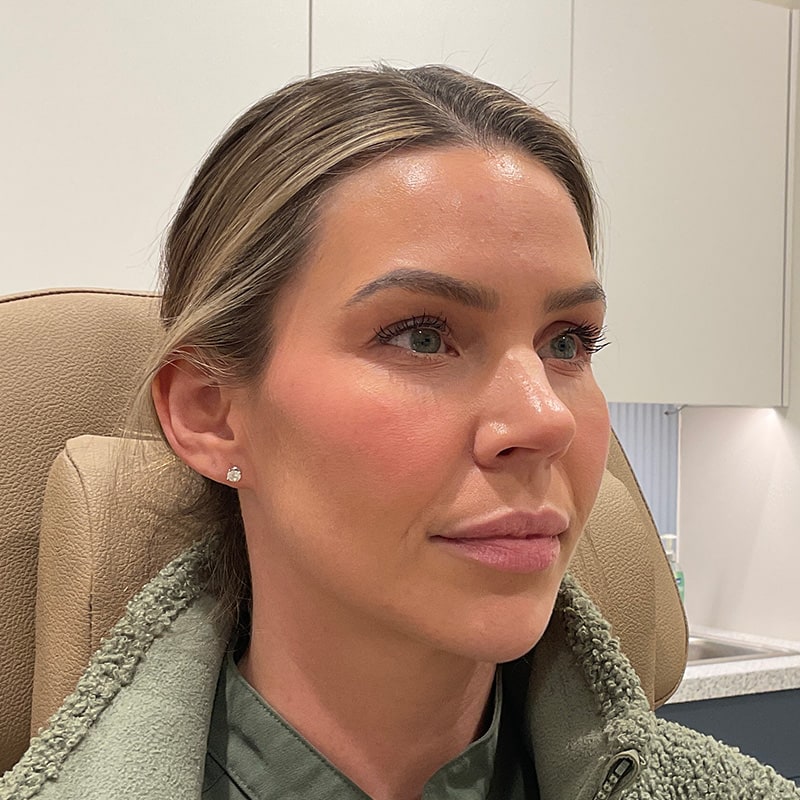 Dermal Fillers Before & After Image