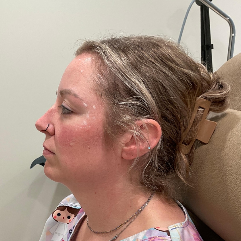 Dermal Fillers Before & After Image