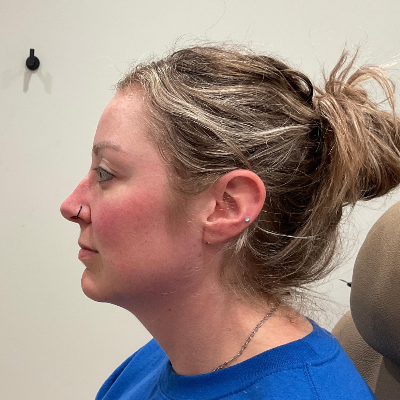 Dermal Fillers Before & After Image