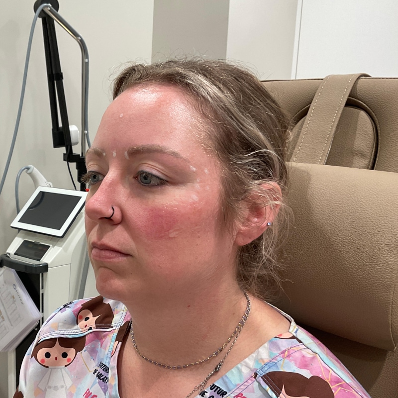 Dermal Fillers Before & After Image