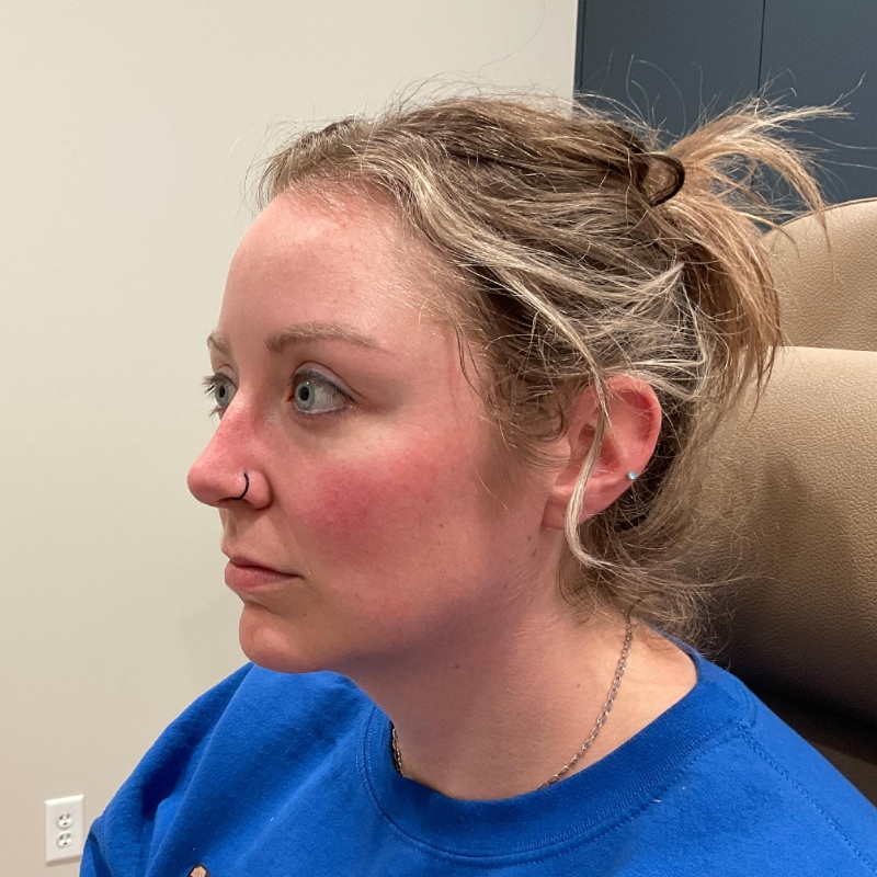 Dermal Fillers Before & After Image