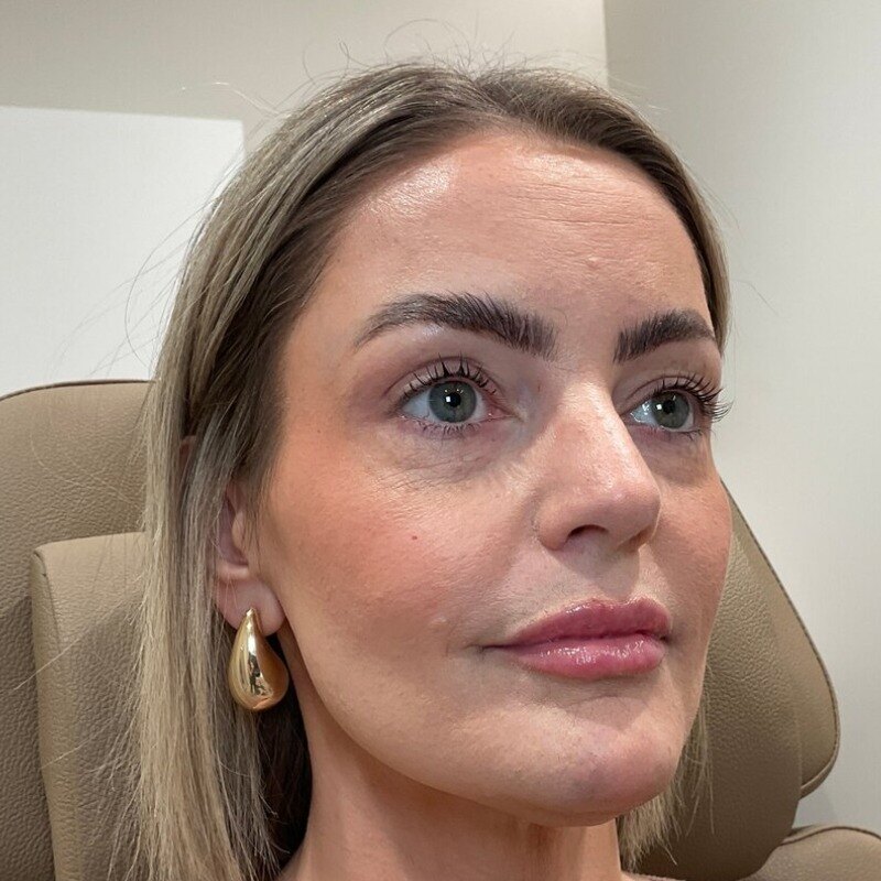 Dermal Fillers Before & After Image