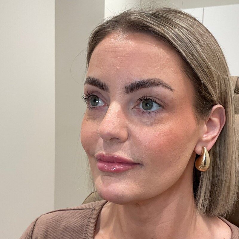 Dermal Fillers Before & After Image