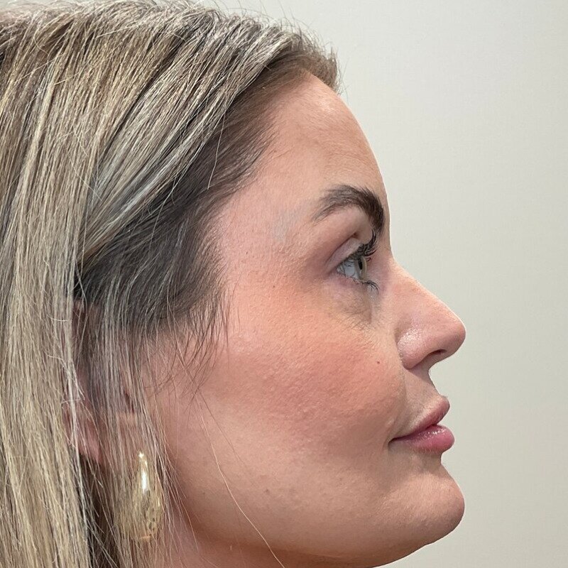Dermal Fillers Before & After Image