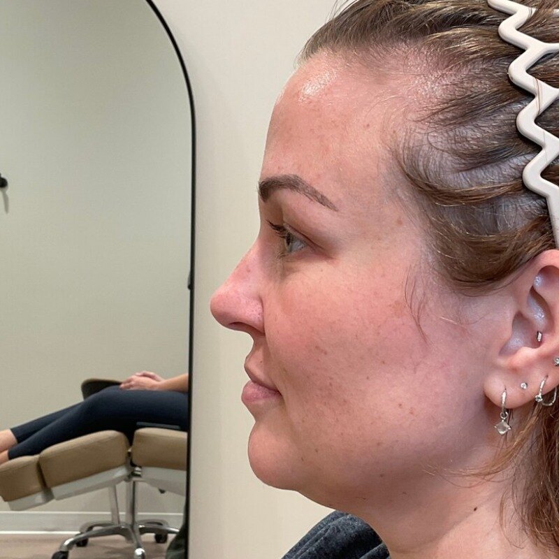 Dermal Fillers Before & After Image