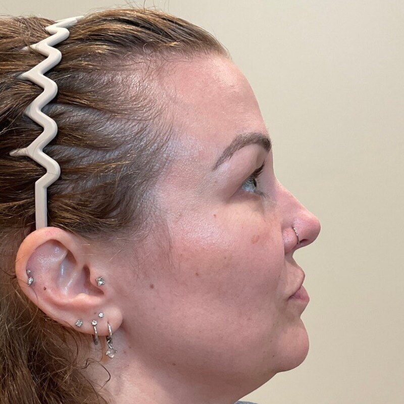 Dermal Fillers Before & After Image