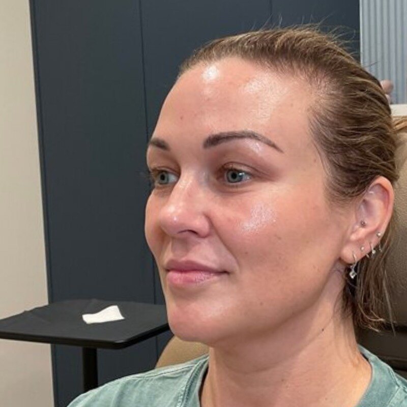 Dermal Fillers Before & After Image